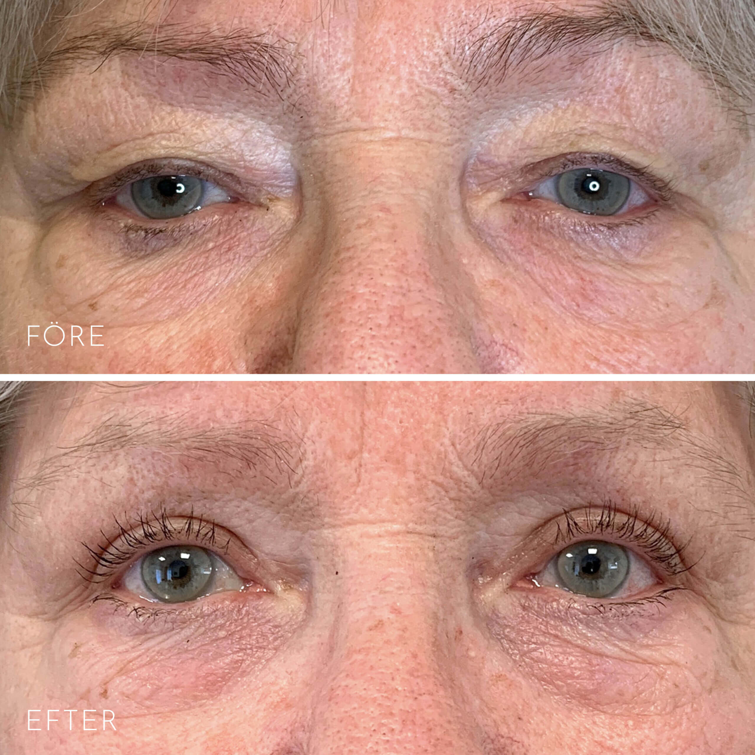 Före och efter bild på persons ögonlock efter behandling av ögonlocksplastik